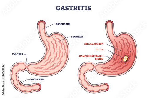 Gastritis as stomach lining inflammation illness and disease outline diagram, transparent background. Labeled educational gastric problem with burning and pain in intestinal tract illustration.
