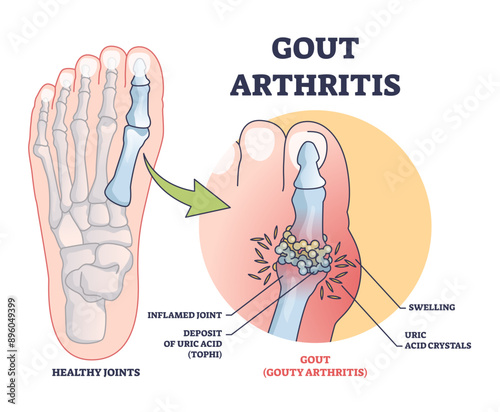 Gouty arthritis with inflamed toe joint painful condition outline diagram, transparent background. Labeled educational scheme.