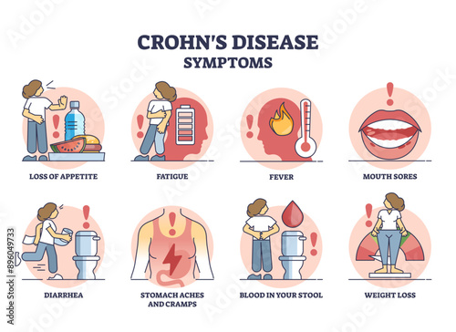 Crohns disease symptoms from inflammatory bowel illness outline diagram, transparent background. Labeled educational medical list of problems from digestive tract inflammation illustration.