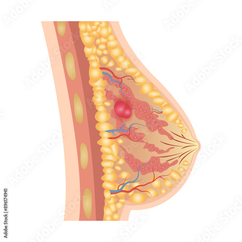 Breast cancer medical vector diagram with a cross-section of female breast anatomical structure and illustration of malignant breast tumor affected by cancer
