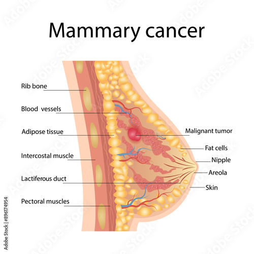 Breast cancer medical vector diagram with a cross-section of female breast anatomical structure and illustration of malignant breast tumor affected by cancer