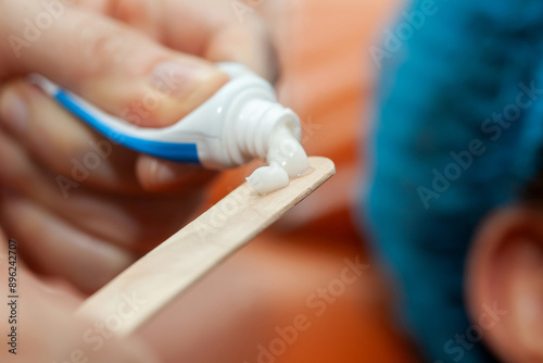 Application of topical anesthesia cream prior to a dermatological procedure.