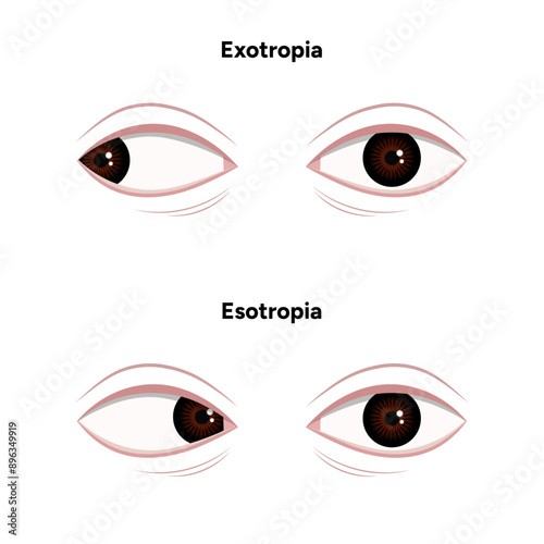 Eye problem disease strabismus Esotropia Exotropia 