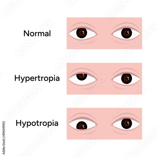 Eye problem disease strabismus normal Esotropia Exotropia Hypertropia Hypotropia
