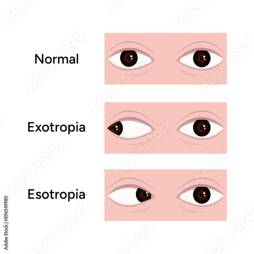 Eye problem disease strabismus normal Esotropia Exotropia