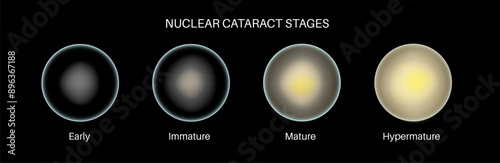 Cataract eye disease