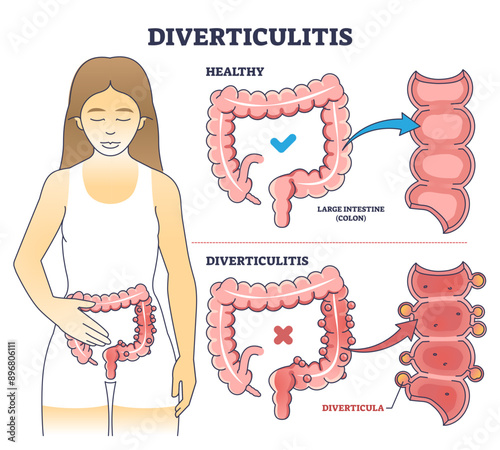 Diverticulitis as digestive conditions for large intestine outline diagram, transparent background.Labeled educational scheme with colon problem illustration.