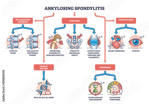 Ankylosing spondylitis as arthritis symptoms or complications outline diagram, transparent background. Labeled educational medical scheme with spine inflammation illness and condition illustration.