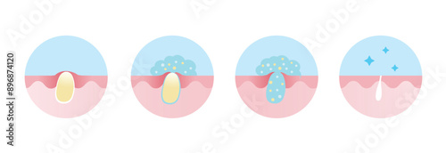 Process of acne pimple treatment vector icon set illustration. Apply salicylic acid on whitehead, penetrate into skin to dissolve closed plugged pore the dead skin cell, sebum and keeping pore clear.