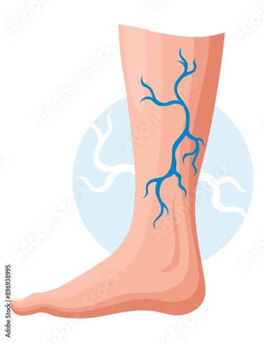 Stages or types of varicose veins development. Medical poster or disease infographic. Image of diseased legs. Vector illustration in flat style
