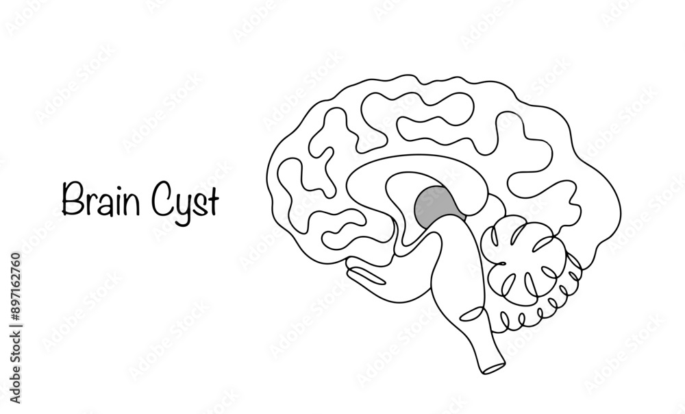 Brain Cyst Brain Cyst