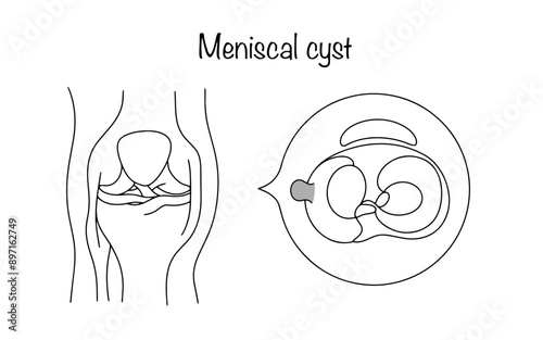 Meniscal cyst