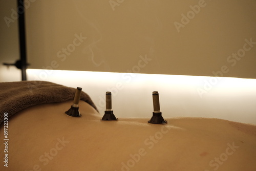 Therapist doing moxa acupuncture treatment on back. 