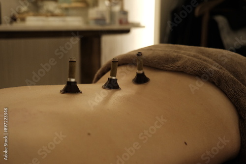 Obraz na płótnie Therapist doing moxa acupuncture treatment on back.