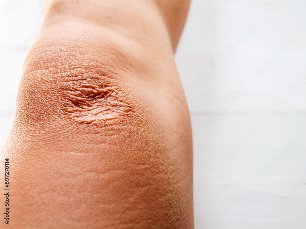 Fototapeta premium Close-up of scars on knee skin imperfections or defects caused by an accident scar healthcare concept