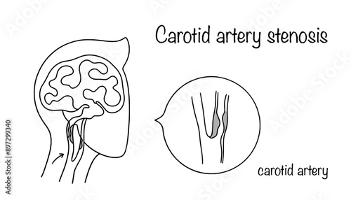 Carotid artery stenosis