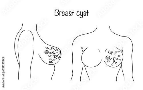 Breast cyst