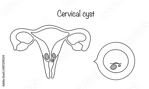 Cervical cyst