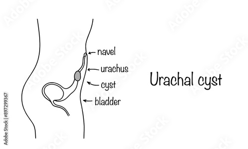 Urachal cyst