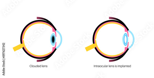Intraocular lenses poster