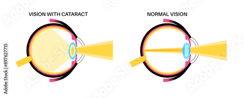 Intraocular lenses poster