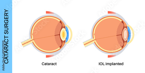 Intraocular lenses poster