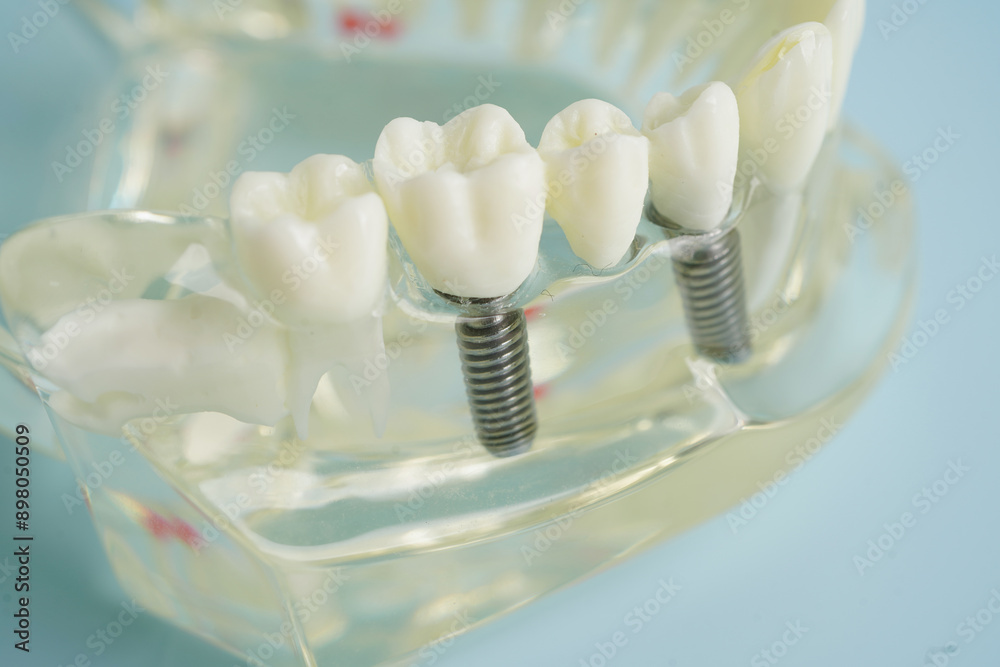 Dental implant, artificial tooth roots into jaw, root canal of dental treatment, gum disease, teeth model for dentist studying about dentistry. Dental implant, artificial tooth roots into jaw, root canal of dental treatment, gum disease, teeth model for dentist studying about dentistry.