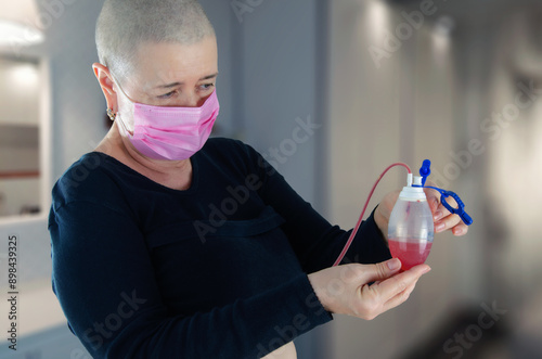 A cancer patient with a shaved head examines the drainage fluid color post-mastectomy, noting the reddish hue typical in early recovery stages.