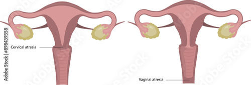Developmental malformations of the uterus, vaginal atresia.
