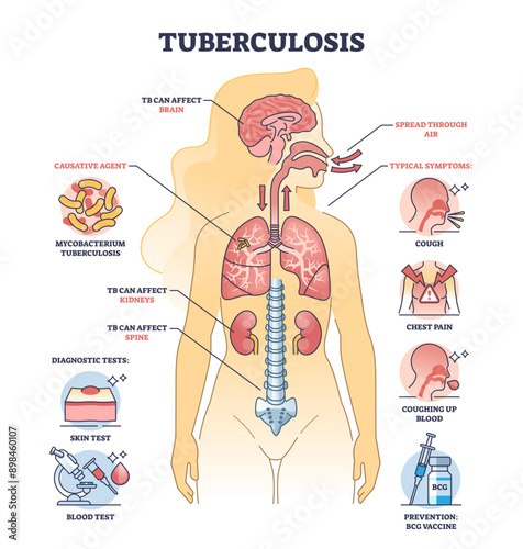 Key aspects of tuberculosis or TB bacterial lung illness outline diagram, transparent background. Labeled educational scheme with respiratory disease with cough.