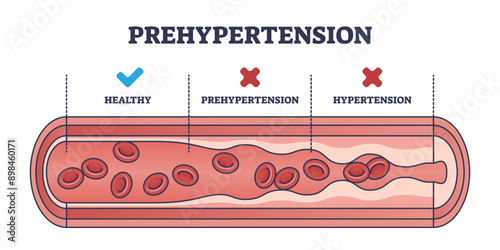 Prehypertension, healthy and hypertension blood flow comparison outline diagram, transparent background. Labeled educational scheme with medical vessels and artery conditions.