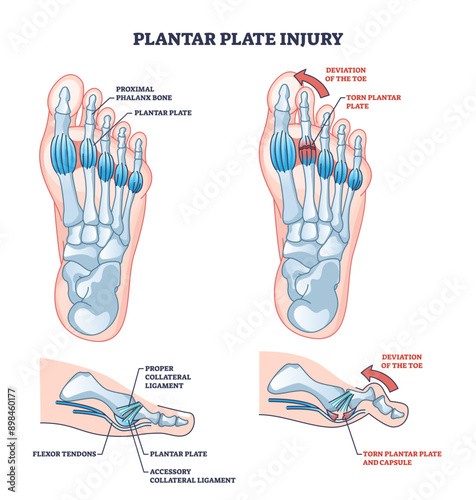 Plantar plate injury anatomy and foot capsule torn trauma outline diagram, transparent background. Labeled educational scheme with skeletal foot problem and toe deviation illustration.