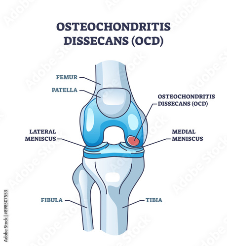 Osteochondritis dissecans or OCD bone and cartilage condition outline diagram, transparent background. Labeled educational scheme.