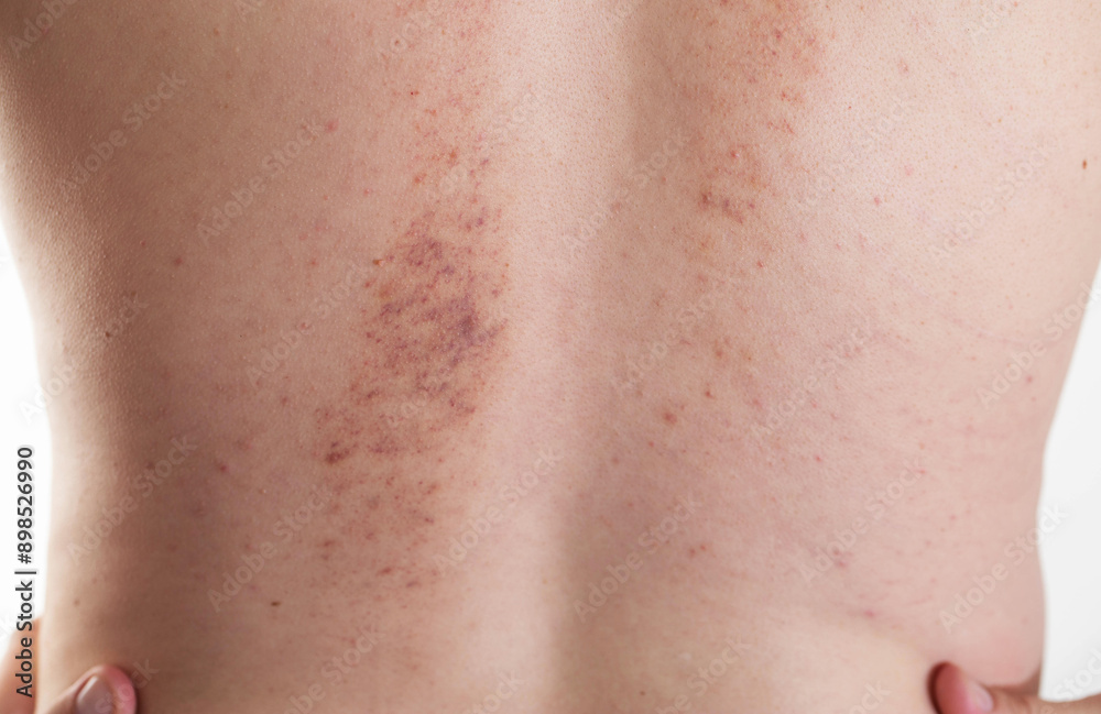 Redness and irritation on the skin of a man s back after a massage. Pimples and red spots with bruises on the skin, close-up Redness and irritation on the skin of a man s back after a massage. Pimples and red spots with bruises on the skin, close-up