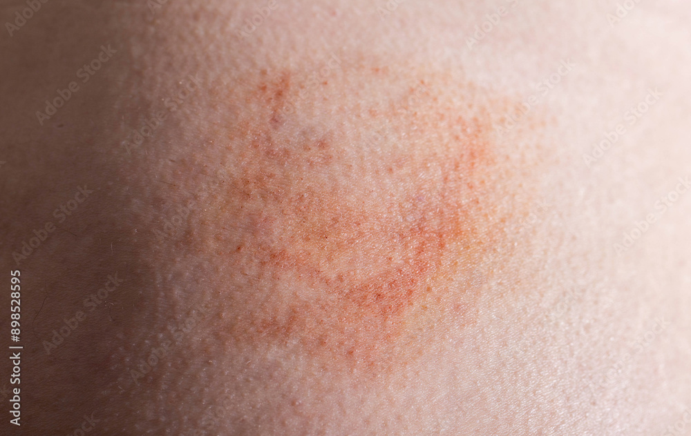 Bruise and subcutaneous lump on the patient s skin after injections. Post-injection infiltrates, close-up Bruise and subcutaneous lump on the patient s skin after injections. Post-injection infiltrates, close-up