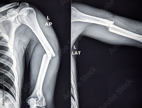 X ray of upper arm showing fracture in the shaft of humerus bone 