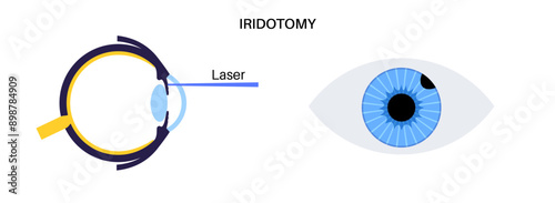 Iridectomy medical poster