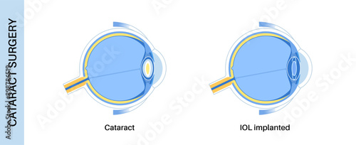 Intraocular lenses poster