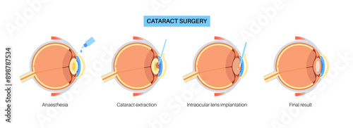 Cataract surgery poster