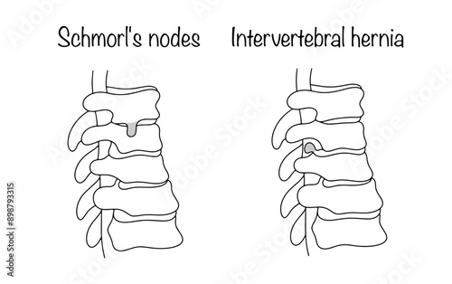 Spinal hernia
