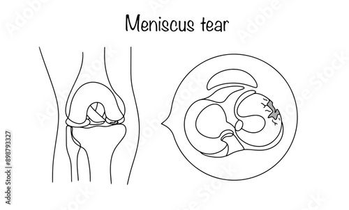 Canvas Print Meniscus tear