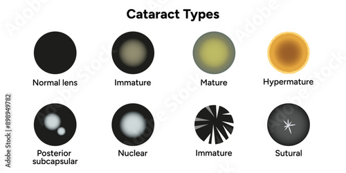 Type cataracts vision disorder problem