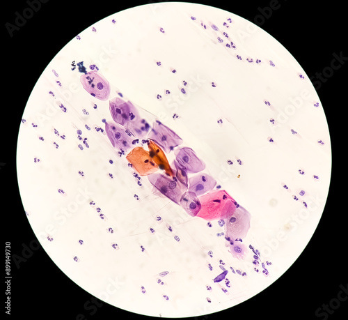 Obraz na plátně Paps smear: NILM with reactive cellular changes associated with inflammation