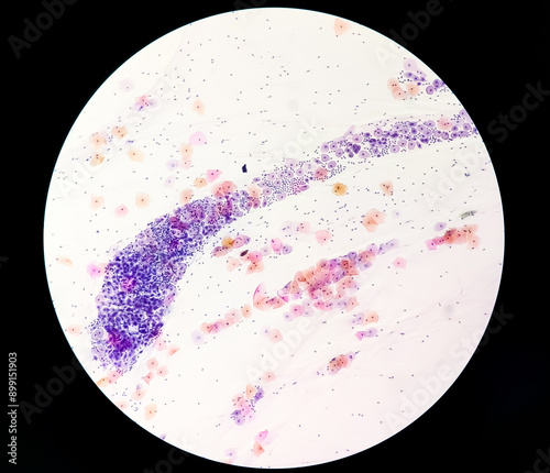 Paps smear: NILM with reactive cellular changes associated with inflammation.