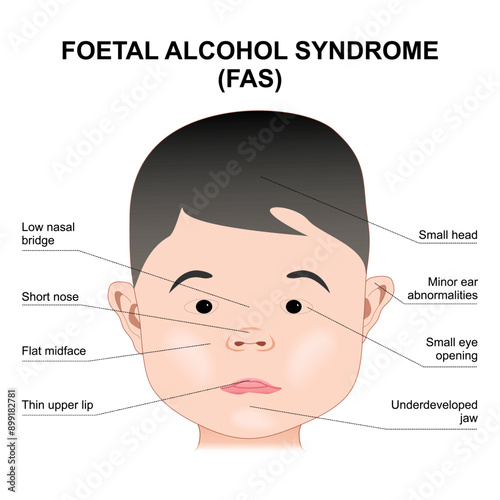 Foetal Alcohol Syndrome Child Illustration
