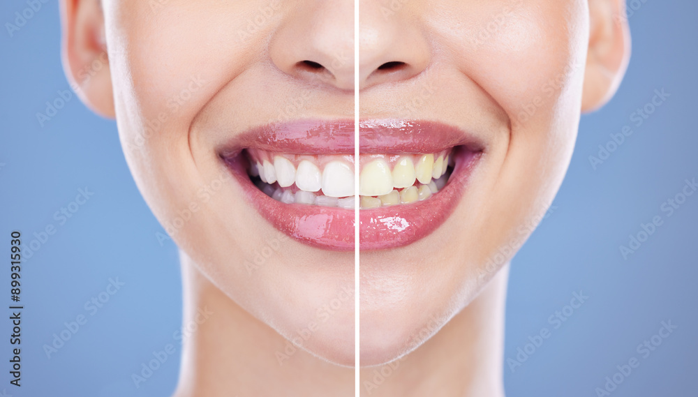 Fototapeta premium Closeup, mouth and woman with teeth, compare and oral hygiene on blue studio background. Enamel, smile and model with oral care, healthy and wellness with treatment for cavity, whitening or dentistry