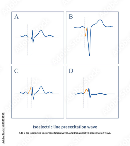 When the ventricular preexcitation wave leaves the baseline and then falls back to the baseline, it is interpreted as an isoelectric line preexcitation wave.
 photo