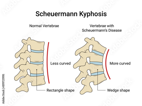 Vertebrae with Scheuermann Kyphosis Disease