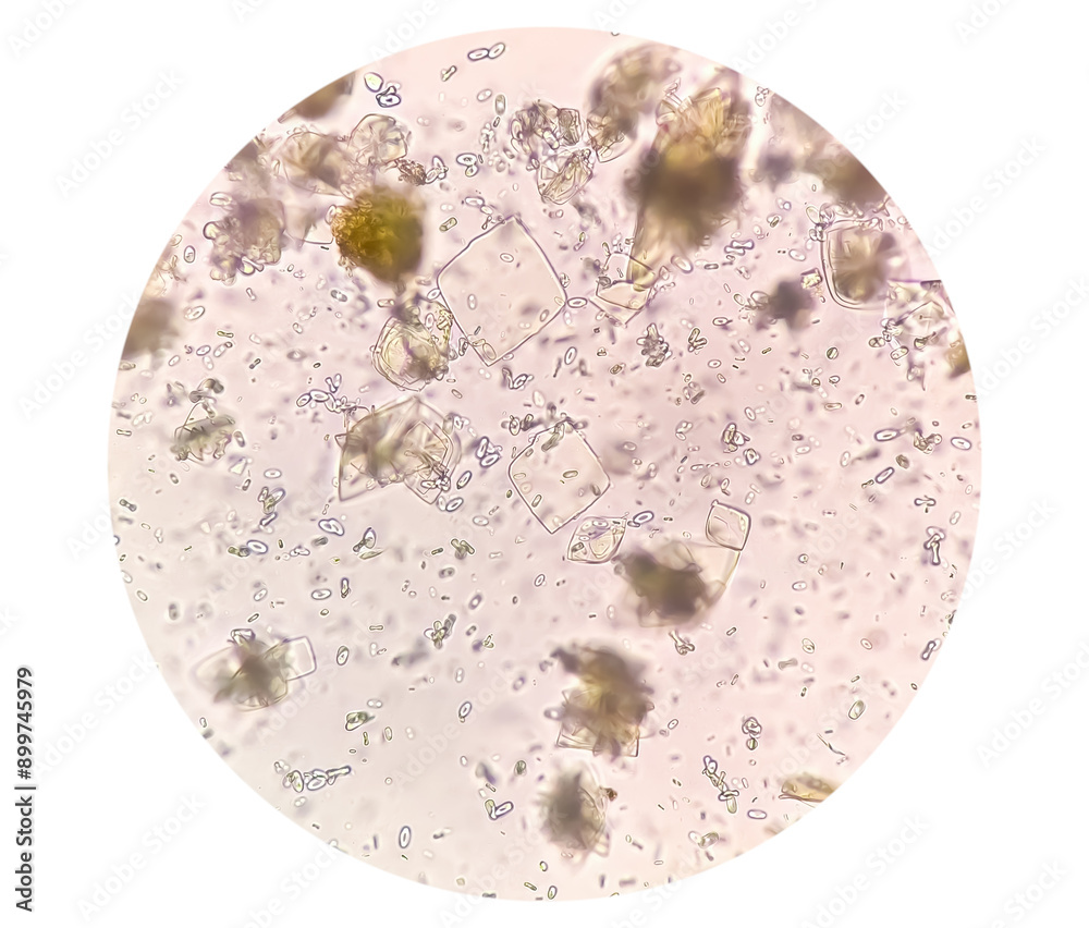 Uric acid crystals and calcium oxalate monohydrate under microscope