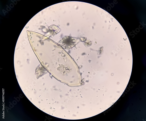 Uric acid crystals and calcium oxalate monohydrate under microscope photo